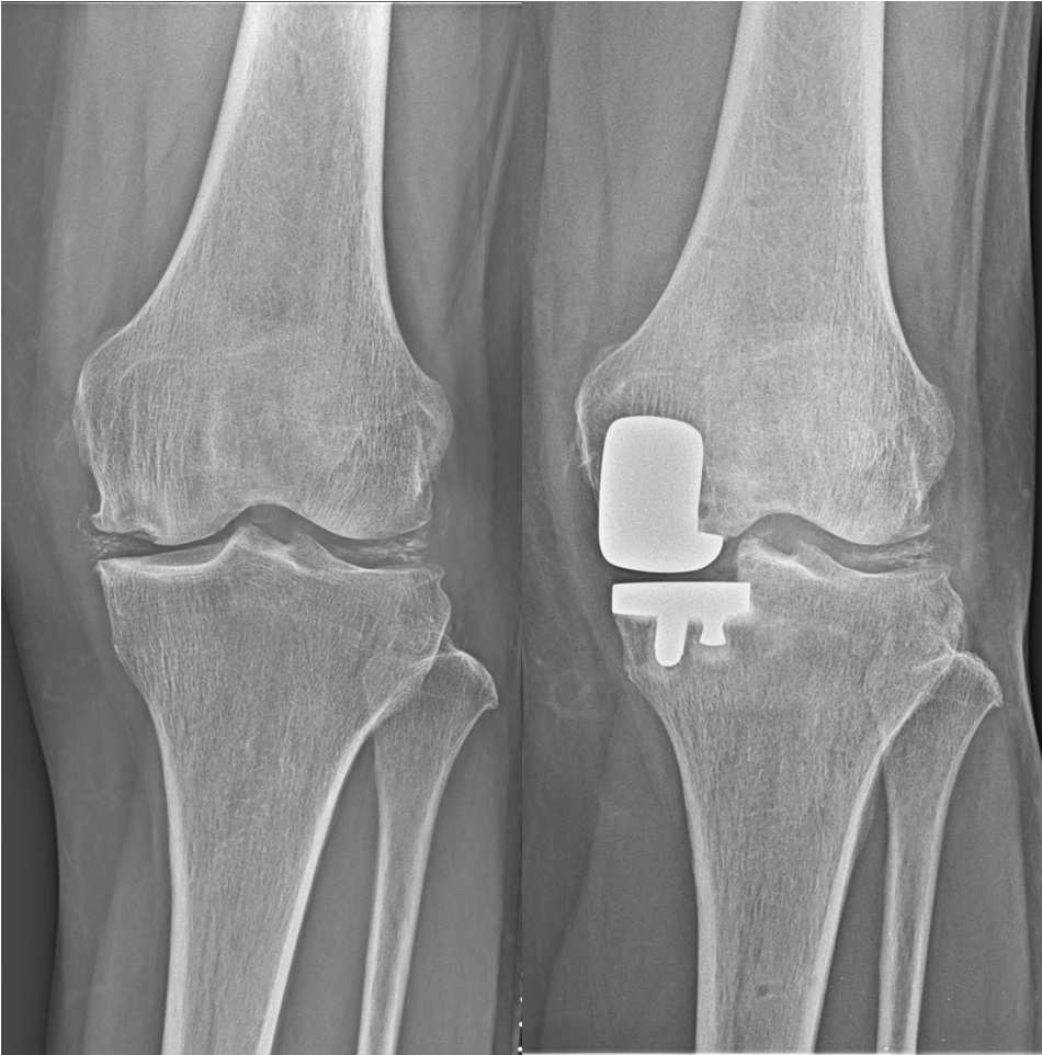 人工膝関節単顆置換術
