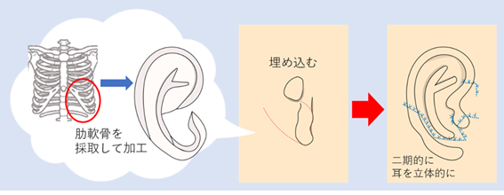 小耳症3.